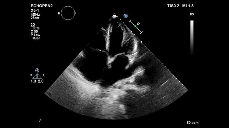 Philips EPIQ CVx